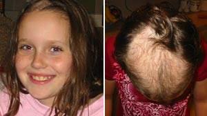 11-Year-old Emily Simmons started pulling her hair out two years ago. What started with just one strand got so bad that her parents eventually shaved her ... - ht_ocd_emily_090731_wmain