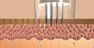 Image result for eclipse micro needling