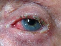 Image result for bacterial conjunctivitis