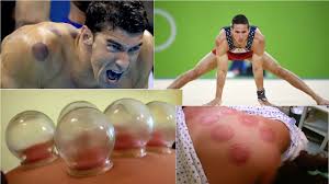 「olympian What is cupping?」的圖片搜尋結果