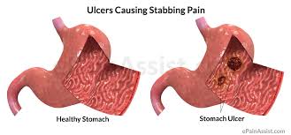 Image result for stomach ulcer