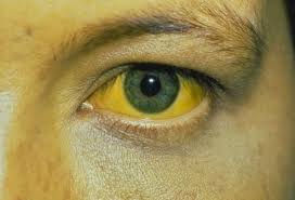 Image result for Complications of Hepatitis