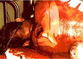 Image result for bomb explosion trauma surgery
