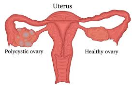 Decoding Polycystic Ovary Syndrome (PCOS): Unveiling Its Causes, Symptoms, and Effective Management - 1