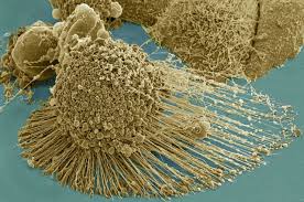 Image result for cancer cell images