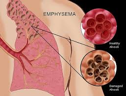Image result for emphysema