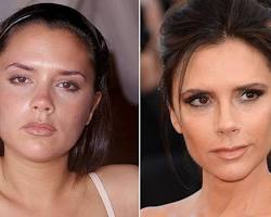 Imagen de Victoria Beckham before and after plastic surgery