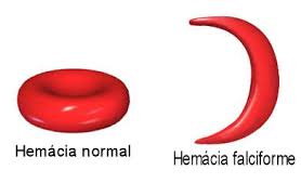 Resultado de imagem para anemia falciforme