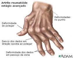 Resultado de imagem para imagens de artrite reumatóide pessoas