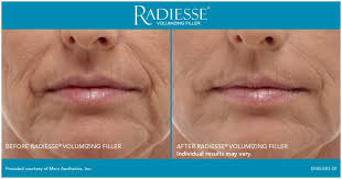 Image result for radiesse before and after