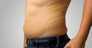 Man - Cellulite (Skinny Fat)
