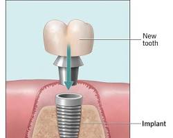 Dental implants can reduce risk of jawbone loss