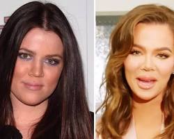 Imagen de Khloé Kardashian before and after plastic surgery
