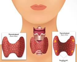 Parathyroid Surgery Middle East