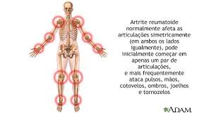 Resultado de imagem para imagens de artrite reumatóide pessoas