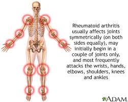 Image result for rheumatoid arthritis pictures