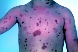 Image result for mastocytosis