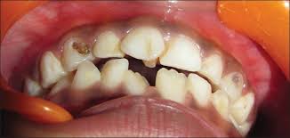 Image result for caries due to supernumerary
