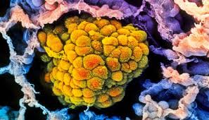 Resultado de imagen de cancer de colon microscopio