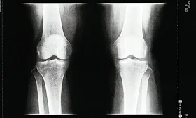 Osteoarthritis: Blood test may spot signs 8 years early