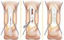 Rupture du tendon d?Achille - m - Chirurgie