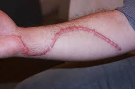 Image result for scars