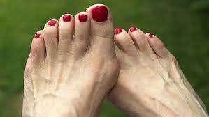 Image result for bunion