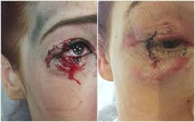 Image result for bomb explosion trauma surgery