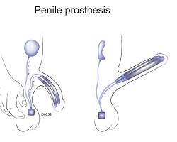 semi-rigid penile prosthesis medical illustration