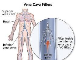 IVC filter