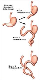 Imagini pentru gastric resection