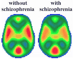 brain imaging, schizophrenia