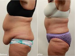 Image result for how to remove belly fats
