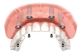 diagram of a denture supported by four dental implants