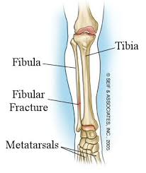 Image result for images of fracture fibula