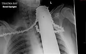 Image result for chainsaw injuries