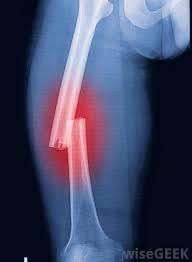 Image result for Treatment of thigh bone fractures with four heads, hand and shoulder and lower bones and upper