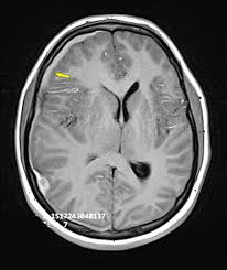 Optimal Perioperative Management of Spontaneous Intracranial Hemorrhage in a Hemophilia A Patient: Overcoming Resource Limitations - 1