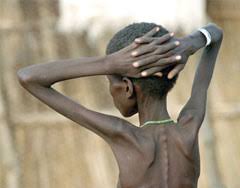 Image result for image of malnutrition