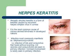 Image result for keratitis meaning