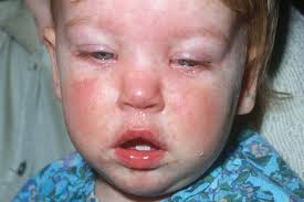 Image result for mumps
