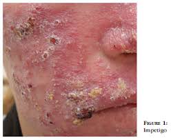 Image result for bacterial skin infection
