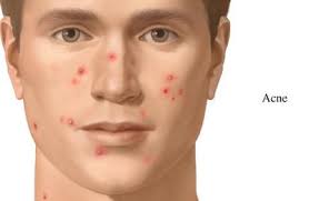 Adult Acne in ladies - Treatment and Causes