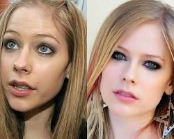 Imagen de Avril Lavigne before and after plastic surgery