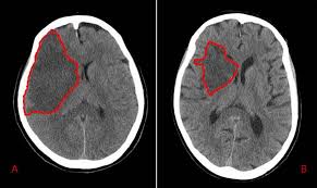 Image result for ct scan brain