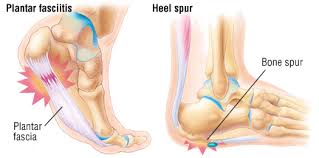 Image result for heel pain