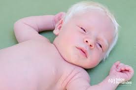Image result for albino people