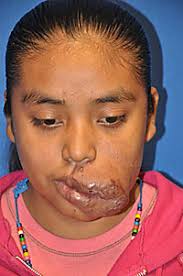 The lesion on Alejandra Gregorio&#39;s face is seen in a photo taken by a medical doctor in 2011, shortly after she arrived in the United States from Mexico. - 1219alejandra4web2
