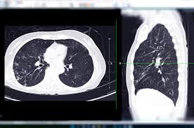 Young Adults With NSCLC More Apt to Get Advanced Disease Diagnosis