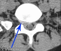 「herniated intervertebral disc  ct」的圖片搜尋結果